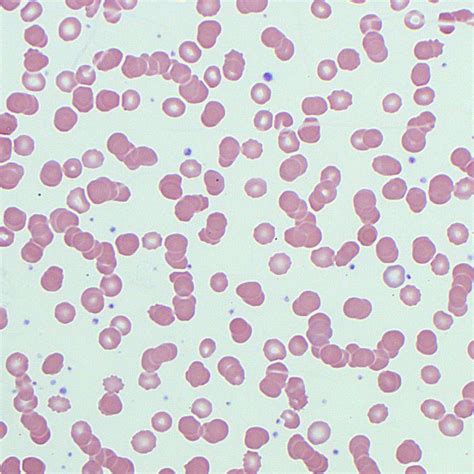 formation rolex|rouleaux formation blood test results.